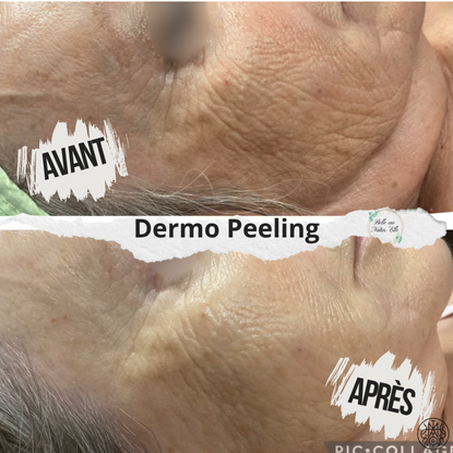 dermo peeling soin eclat visage clermont ferrand